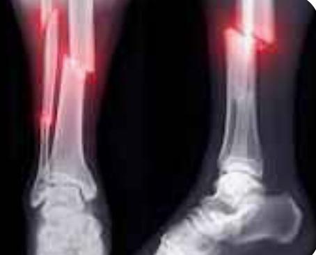 Fracture