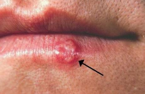 Herpes