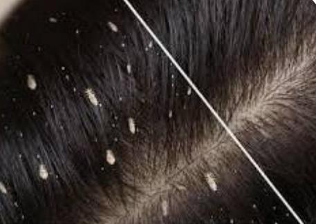 Lice Infestation on the Head