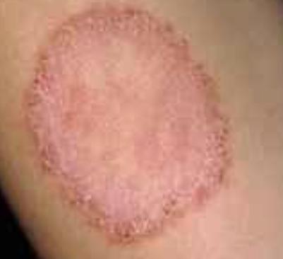 Ringworm